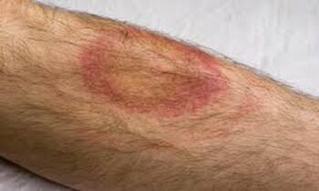 Ein Anzeichen für Borreliose ist ein roter Ring der wächst und sich nach aussen verschiebt